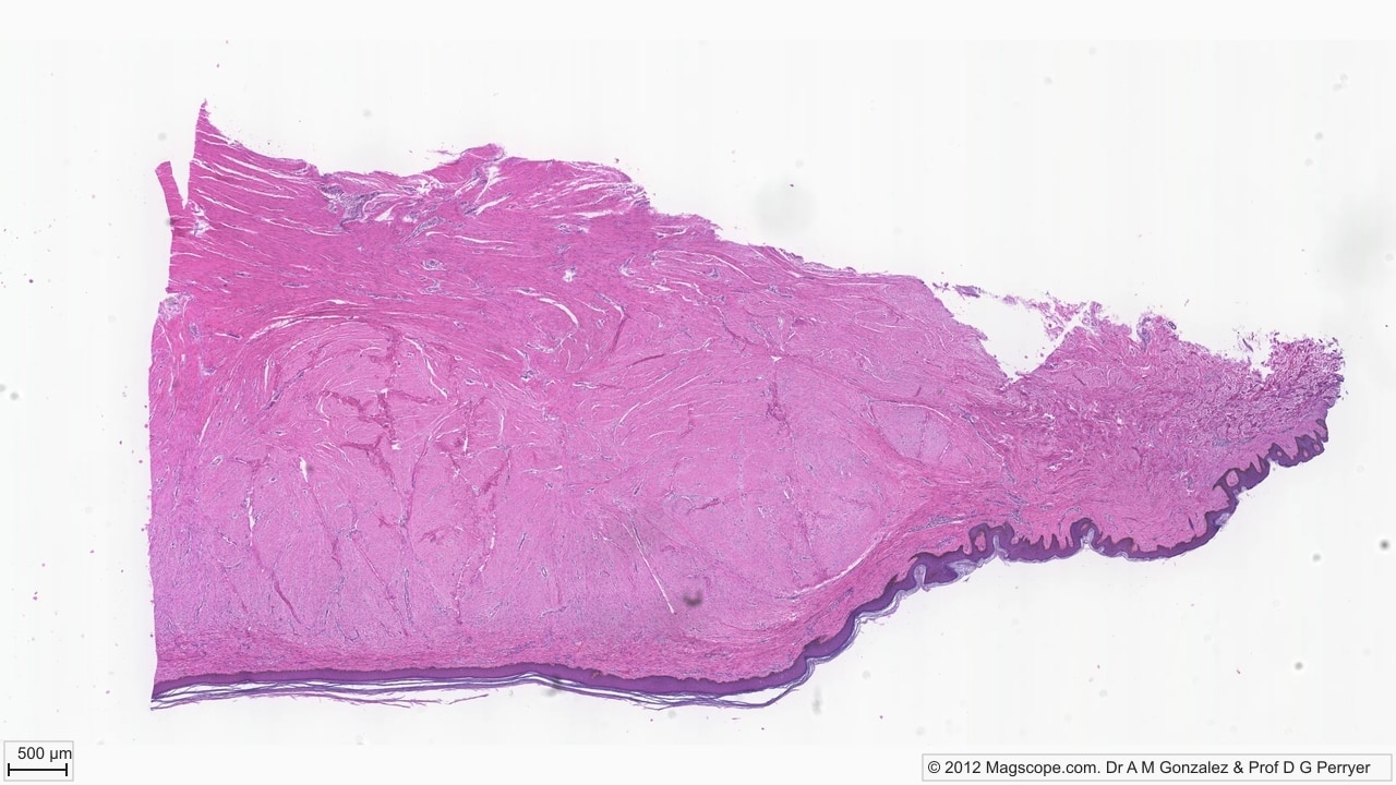 Pigmented skin overview. Dense collagenous dermis fills most of the section, with a dark keratinised epidermal band and folded rete ridges along the surface.