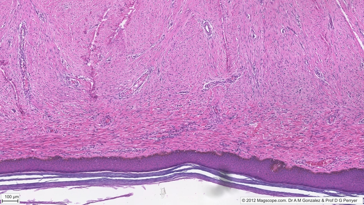 Melanin and keratin. Brown melanin is concentrated near basal and lower spinous keratinocytes, while partly lifted stratum corneum forms pale keratin sheets at the surface.