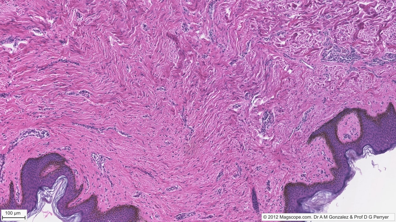 Folded pigmented epidermis. Deep rete ridges alternate with dermal papillae, while dense irregular connective tissue contains wavy collagen bundles, vessels and fibroblast nuclei.