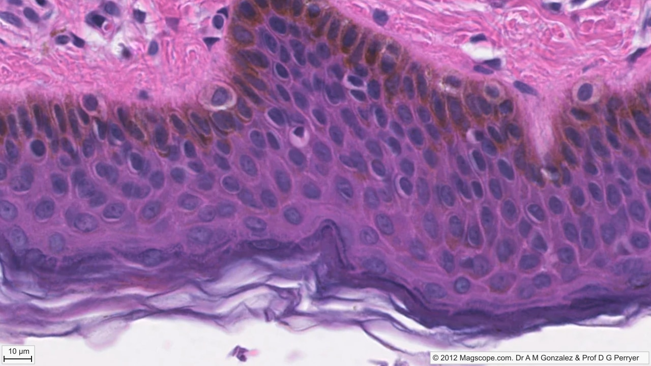 Pigment close-up. Brown melanin granules are prominent in basal and lower suprabasal keratinocytes near the dermal junction, while lifted stratum corneum marks the free surface.
