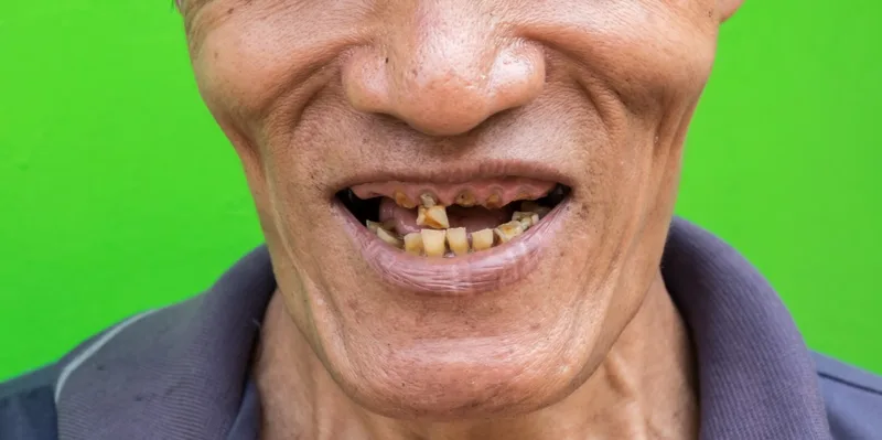 Close-up of older man's mouth with damaged teeth