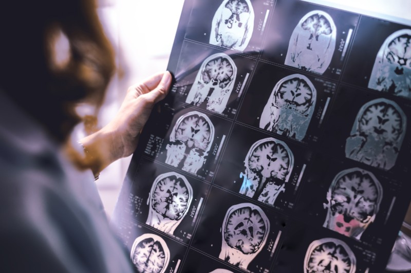 Hand holding sheet of brain MRI scans