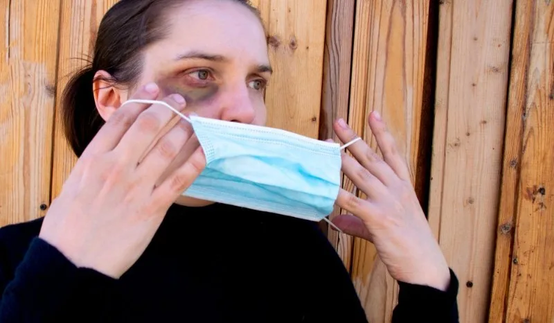Person with visible facial bruising holding a face mask